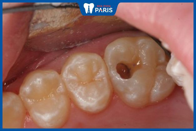 Răng bị thủng lỗ nhỏ, cách khắc phục sớm